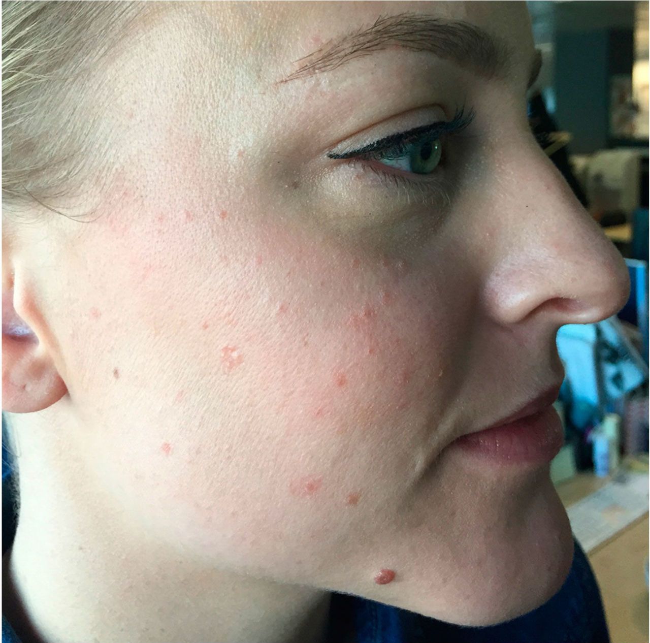 Twizzler reccomend acne mature skin