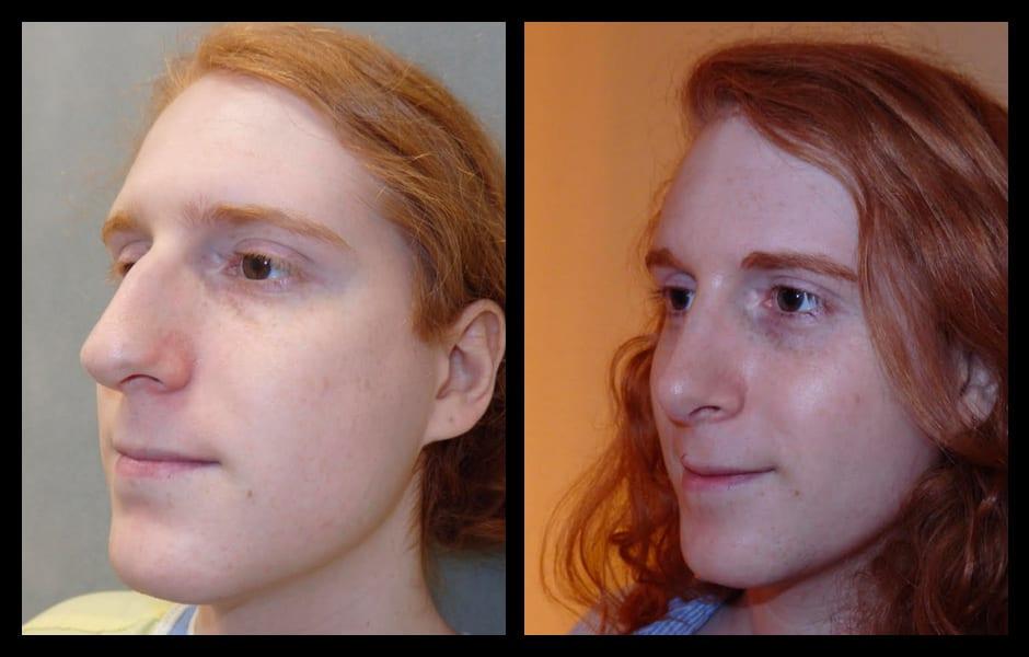 best of Surgery facial feminazation